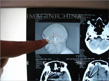 Cụ bà mang viên đạn trong đầu từ Thế chiến thứ 2 - 1