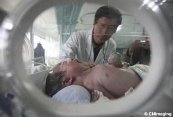 Một em bé có tim nằm ngoài lồng ngực - 1 Một em bé có tim nằm ngoài lồng ngực - 1