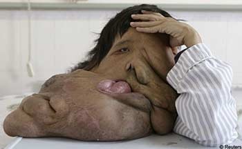 “Người voi” đi phẫu thuật lần 2 - 1