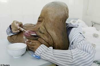 “Người voi” đi phẫu thuật lần 2 - 2