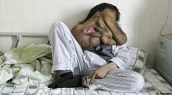 “Người voi” đi phẫu thuật lần 2 - 3