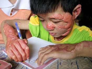 Ước mơ của cháu bé bị cha đốt khi đang ngủ - 2