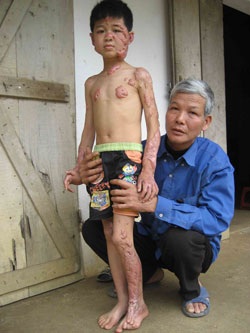 Ước mơ của cháu bé bị cha đốt khi đang ngủ - 1