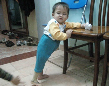 Cuộc sống mới của cháu bé bị súc vật cắn một phần cơ thể - 2 Cuộc sống mới của cháu bé bị súc vật cắn một phần cơ thể - 2