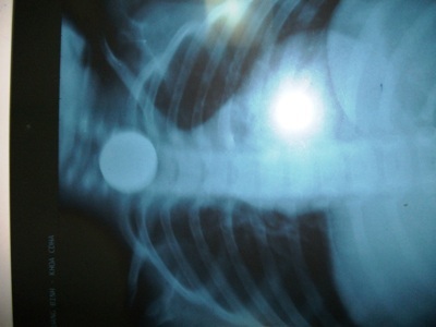 Cứu sống cháu bé 3 tuổi nuốt đồng tiền xu - 1