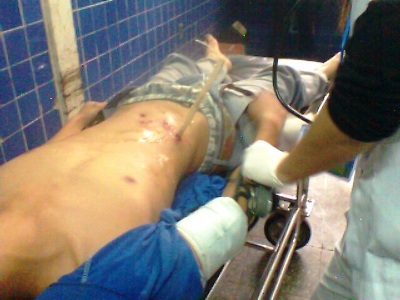 Bị gỗ đâm thủng bụng khi xẻ gỗ làm nhà