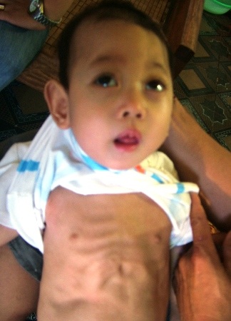 Lồng ngực của bé Lâm lộ ra rất nhiều xương do bị viêm phổi nặng