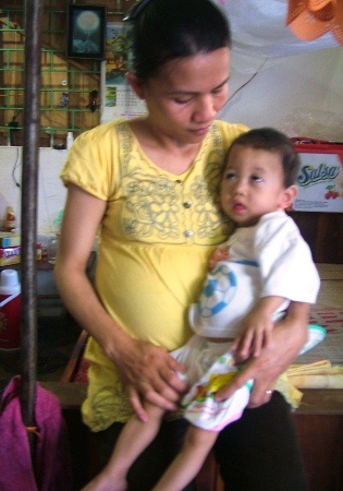 Lồng ngực của bé Lâm lộ ra rất nhiều xương do bị viêm phổi nặng