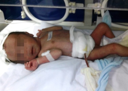 Cứu sống bé sơ sinh lòi gần nửa bộ ruột ra ngoài bụng - 1 Cứu sống bé sơ sinh lòi gần nửa bộ ruột ra ngoài bụng