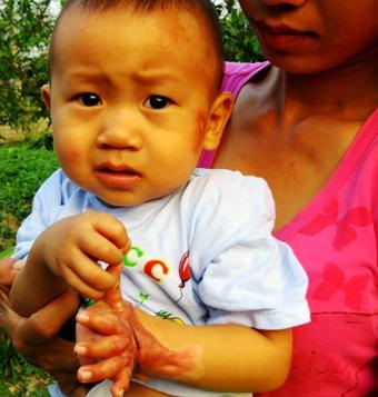 Ngã vào bếp lửa, cháu bé 17 tháng tuổi có nguy cơ mất cả bàn tay