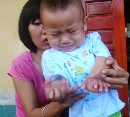 Ngã vào bếp lửa, cháu bé 17 tháng tuổi có nguy cơ mất cả bàn tay