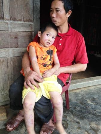 Căn bệnh ngứa quái ác hành hạ đã khiến bé Trà Giang không một phút yên thân