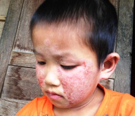 Khuôn mắt khôi ngô của bé chằng chịt vết vảy do ngứa
