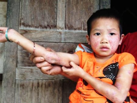 Chịu không nổi nên đêm ngày, bé gãi ra máu, trông rất tội nghiệp