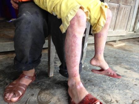 Những mảng vảy đỏ chót ở chân