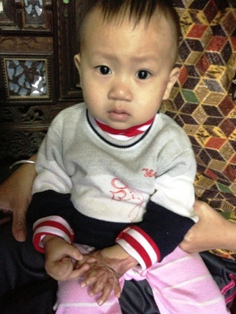 Gần 19 triệu đồng đến với bé 17 tháng tuổi ngã vào bếp lửa