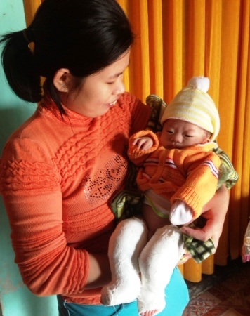 Đôi chân của bé Tấn đang dần phục hồi