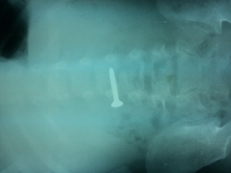 Chiếc đinh vít dài khoảng 3cm trong bụng bé D