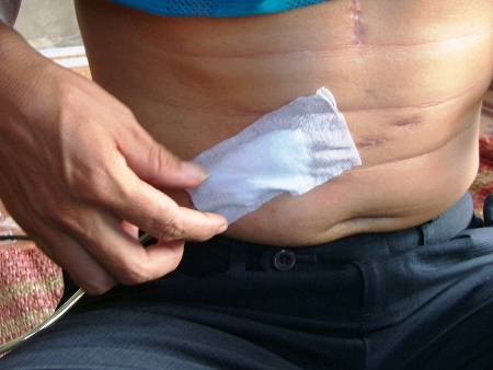 Điểm nối giữa bộ sạc điện vào trong cơ thể để giúp anh duy trì sự sống