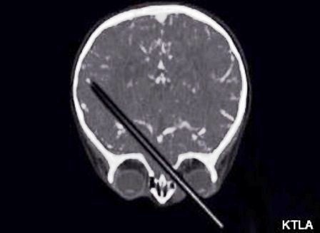 Chiếc bút chì dài 13cm đâm xuyên qua mắt đi thẳng vào não