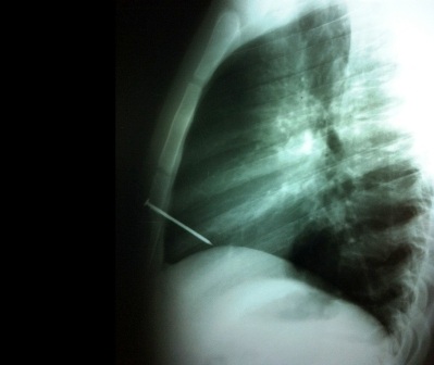 Ảnh X-Quang cho thấy chiếc đinh đâm thẳng vào khoang tim