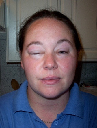 Với chứng bệnh kỳ lạ này, chị 