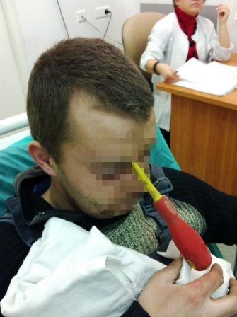 Soi gương mới phát hiện thấy tua-vít đâm xuyên đầu