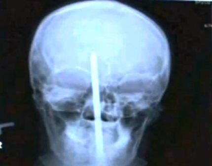 Chiếc tua-vít đâm xuyên qua trán nhưng lệch não