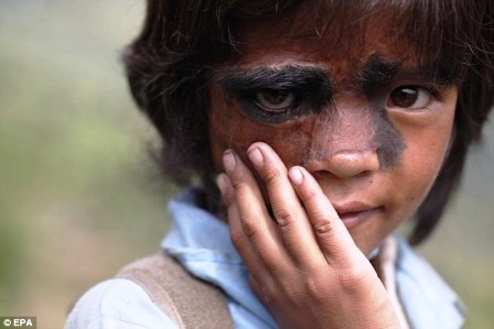 Lông tóc trên khuôn mặt của bé Bhawana phần nào đã được loại bỏ