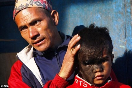 Anh Kaluman cùng với bé Bhawana