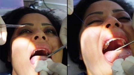 Giảm béo kỳ quặc bằng cách khâu lưỡi - 1 Giảm béo hiệu quả bằng cách… khâu lưỡi