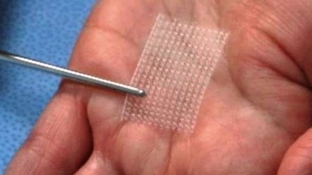 Giảm béo kỳ quặc bằng cách khâu lưỡi - 2 Cấu tạo miếng vá kỳ diệu