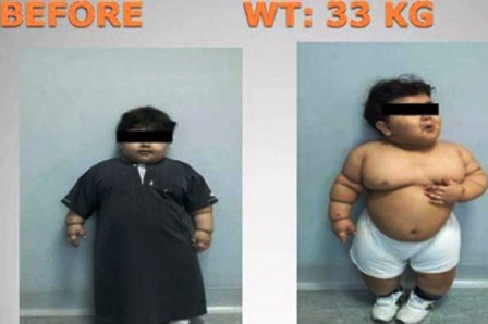 Bé 2 tuổi được phẫu thuật dạ dày để giảm béo - 1 Bé trai trước khi phẫu thuật