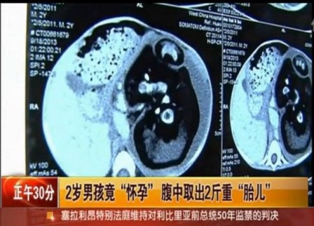 Trung Quốc: Bé trai 2 tuổi mang bào thai ký sinh - 2 Bào thai chiếm 2/3 thể tích phần bụng của bé