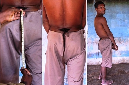 Anh Chandre Oraon lúc sinh ra đã có chiếc đuôi