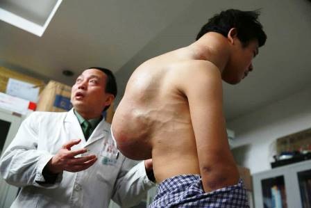 Người “cõng” khối u nặng 10kg - 1 Xiao Yang với khối u nặng 10kg trên lưng