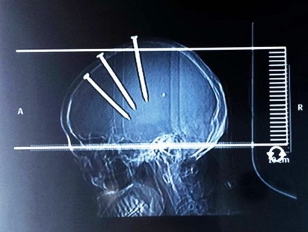 Sống sót kỳ diệu khi bị 3 chiếc đinh dài 10cm đâm vào đầu