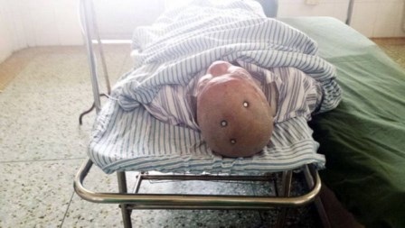 Sống sót kỳ diệu khi bị 3 chiếc đinh dài 10cm đâm vào đầu