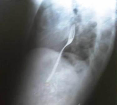 Nhập viện vì trò cá cược nuốt dĩa vào bụng - 1 Ảnh chụp X-quang