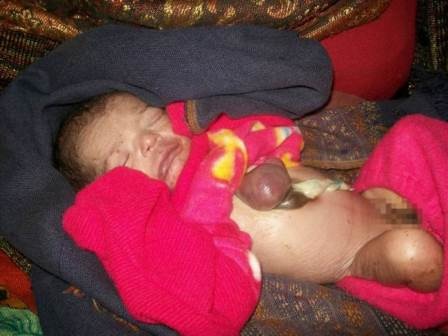 Em bé chào đời với trái tim nằm ngoài lồng ngực