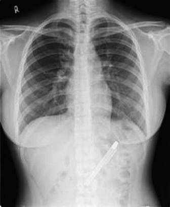 Bút nằm trong dạ dạy suốt 6 tháng mà không biết - 2 Ảnh chụp X-quang cho thấy chiếc bút trong bụng bệnh nhân.