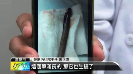 Bút nằm trong dạ dạy suốt 6 tháng mà không biết - 1 Bút nằm trong dạ dạy suốt 6 tháng mà không biết