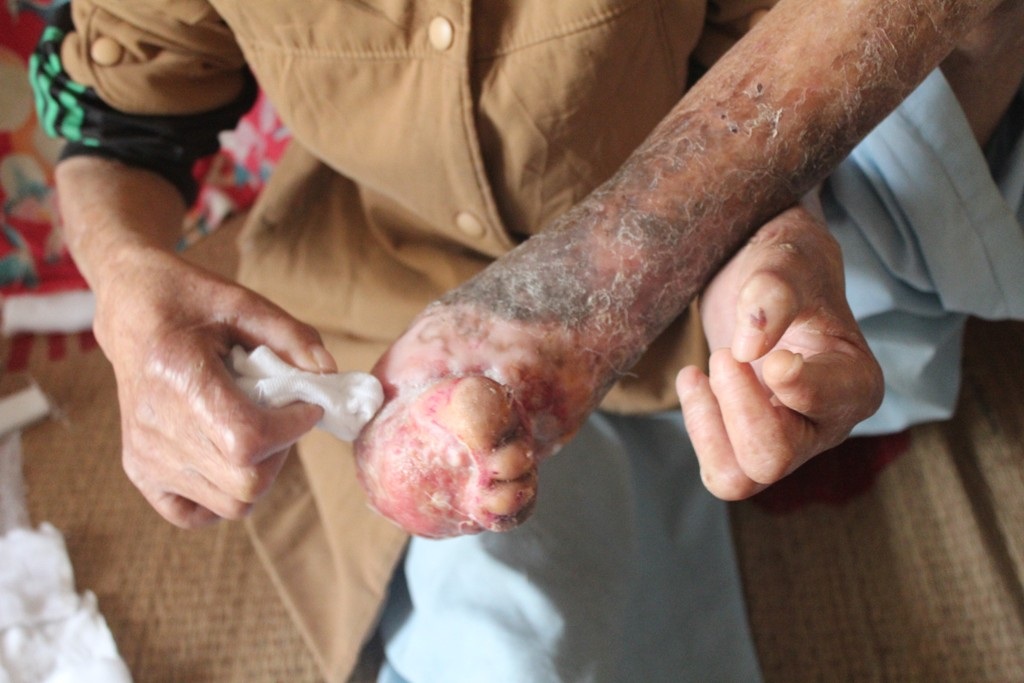 Cơ thể biến dạng, mất đi từng bộ phận vì căn bệnh
quái ác ăn mòn.