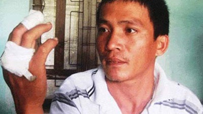 Hy hữu người đàn ông bị thương vì điếu thuốc phát nổ - 1 Hy hữu người đàn ông bị thương vì điếu thuốc phát nổ - 1