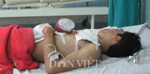 Đốt pháo, nổ nát hai bàn tay - 1 Đốt pháo, nổ nát hai bàn tay - 1