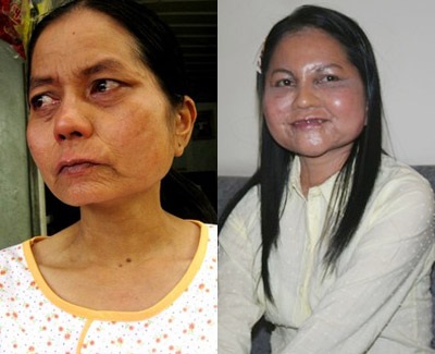 “Cô gái hóa bà lão” bất ngờ trẻ lại nhờ cấy mỡ dưới da - 1 “Cô gái hóa bà lão” bất ngờ trẻ lại nhờ cấy mỡ dưới da