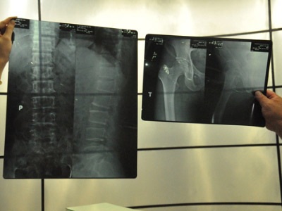 Một bệnh nhân bị các bác sĩ ghép xén phim X-quang ở BV