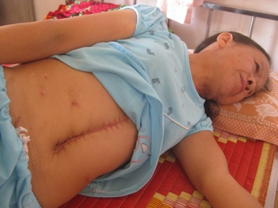 Ngặt nghèo người phụ nữ đơn thân chật vật sau cơn bạo bệnh - 1 Những vết sẹo trong lần phẫu thuật gần đây