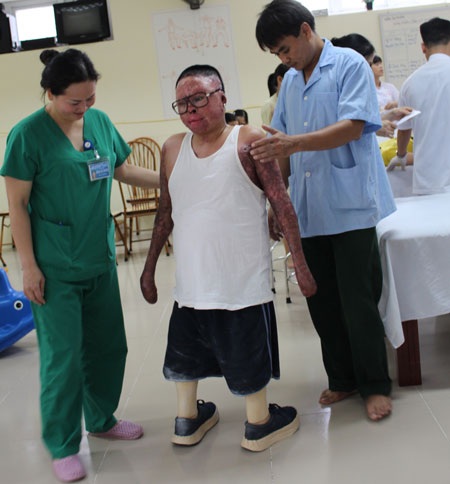 Nghị lực phi thường của người lính sống sót sau vụ máy bay rơi - 1 Thượng úy Đinh Văn Dương đang tập những bước đi đầu tiên với đôi chân giả. Ảnh: MỘC MIÊN