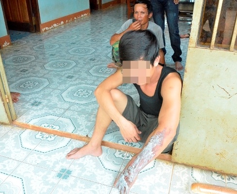 Anh Long bị bỏng ở phần mặt và tay khi vào can ngăn 